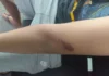 Trio de adolescentes rouba e agride vítima no Riacho Fundo 2